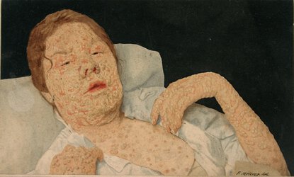 past-pandemics-variola-blisters.jpg